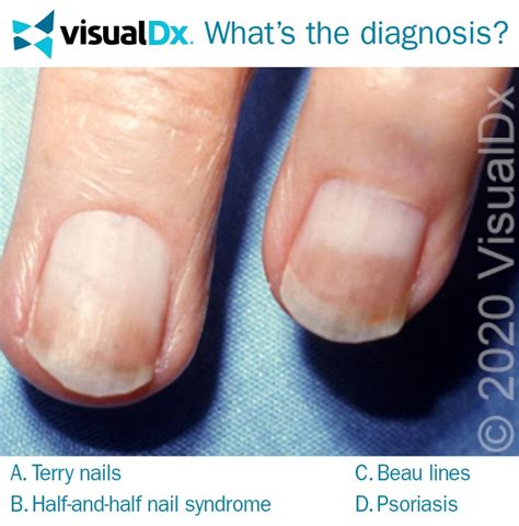 livery nails|causes of fingernails turning white.